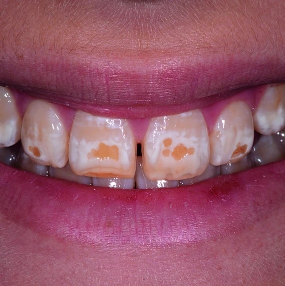 DMG Flairesse Bleaching Gel - zastosowanie